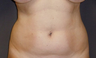 Liposuction