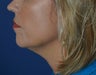 40 year old female after a liquid neck lift