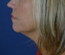 40 year old female after a liquid neck lift