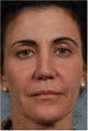 50 Year Old Female with loss of facial volume