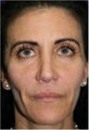 50 Year Old Female with loss of facial volume