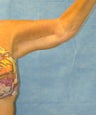 64 Year Old Female Treated for Bilateral Excess/Laxity Skin of Upper Arm