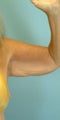 64 Year Old Female Treated for Bilateral Excess/Laxity Skin of Upper Arm