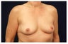 Breast Lift