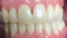 Anterior crossbite with Invisalign
