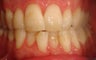 Anterior crossbite with Invisalign