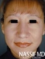 HIspanic Female Rhinoplasty