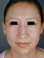 HIspanic Female Rhinoplasty