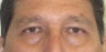 56 year old Asian male who underwent upper lid blepharoplasty surgery