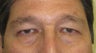 56 year old Asian male who underwent upper lid blepharoplasty surgery