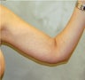 Brachioplasty