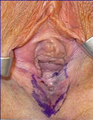 Vaginoplasty Before and After in the OR