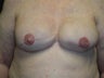 Nipple reconstruction