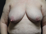 Nipple reconstruction