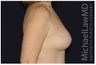 Breast Lift