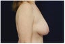 Breast Lift