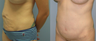 32 Year Old Female Underment a Full Abdominoplasty ( Tummy Tuck)