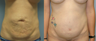 32 Year Old Female Underment a Full Abdominoplasty ( Tummy Tuck)