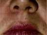 Laser Hair Removal