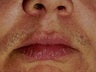 Laser Hair Removal