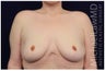 Breast Lift - Mastopexy
