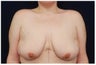 Breast Lift - Mastopexy