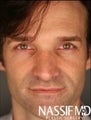 Male Primary Rhinoplasty