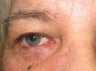 This photo shows a squamous cell carcinoma of the right lower lid that after its complete excision, was left with a defect