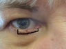 This photo shows a squamous cell carcinoma of the right lower lid that after its complete excision, was left with a defect