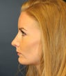 Revision Rhinoplasty to Correct Irregularities