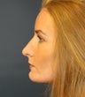 Revision Rhinoplasty to Correct Irregularities