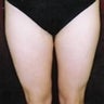 Female patient who underwent a thigh lift