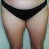 Female patient who underwent a thigh lift