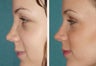 4 female who broke her nose in an automobile accident