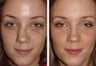 4 female who broke her nose in an automobile accident