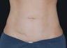 CoolSculpting
