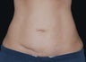 CoolSculpting