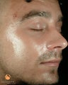 Male treated with 4 Photodynamic Therapy with Levulan for acne