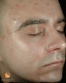 Male treated with 4 Photodynamic Therapy with Levulan for acne