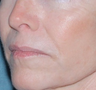 Laser Resurfacing for Wrinkles