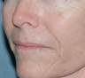 Laser Resurfacing for Wrinkles