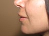 kissable lips - lip augmentation using fat transfer