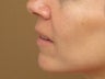 kissable lips - lip augmentation using fat transfer