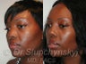 Ethnic Rhinoplasty