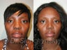 Ethnic Rhinoplasty