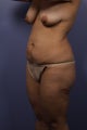40 yr old Mommy Makeover