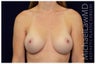 Breast Augmentation