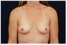 Breast Augmentation