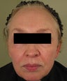 Facial rejuvenation with Sculptra, Dermapen, and Botox