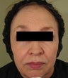 Facial rejuvenation with Sculptra, Dermapen, and Botox